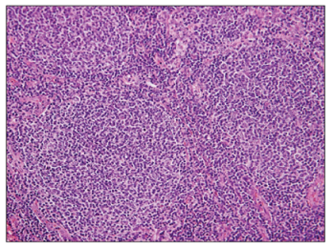 Folikulární lymfom G1, hematoxylin – eosin, zvětšení 200x.