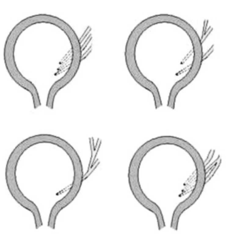 <i>Smithova klasifikácia triplikácie močovodu</i>
Fig. 4. <i>Smith’s classification of ureteral triplication</i>
