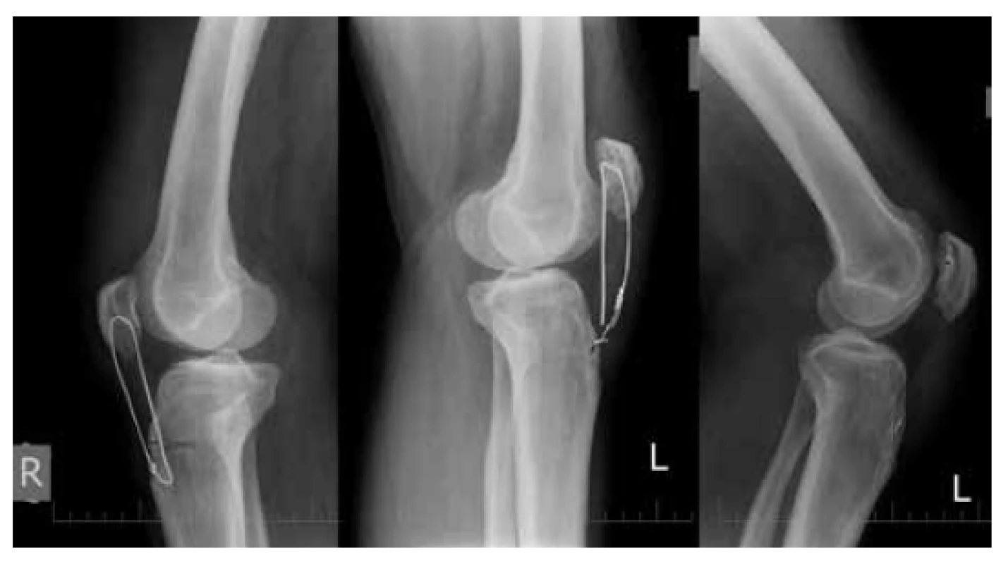 RTG snímky oboch kolien 3 mesiace po operácii
  bilaterálnej ruptúry <i>ligamentum patellae</i>
Roztrhnutie serklážnej slučky vľavo. RTG snímka po extrakcii
serklážnej slučky vľavo. Postavenie patelly obojstranne vyhovuje
(Insall-Salvati ratio=0,96).<br>
Fig. 4: Lateral views of both knees 3 months after bilateral
patellar tendon suture
Broken cerclage wire on the left knee. Correct patellar position
on both knees (Insall-Salvati ratio=0.96).