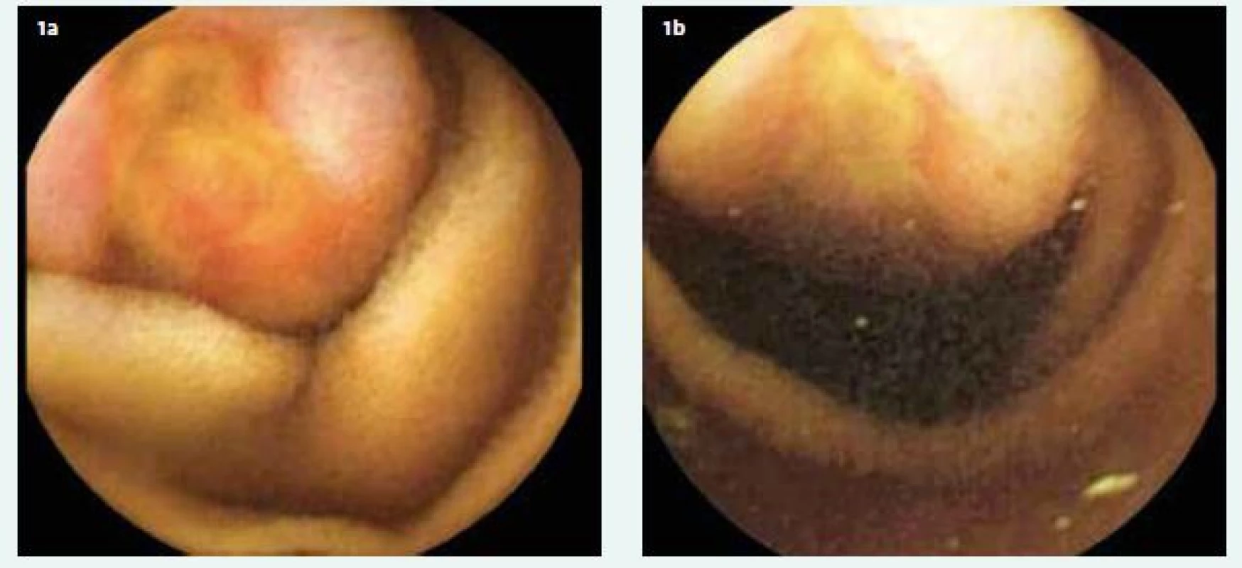 a, 1b. CE showing an ulceration with thickened edges of 2 cm in size