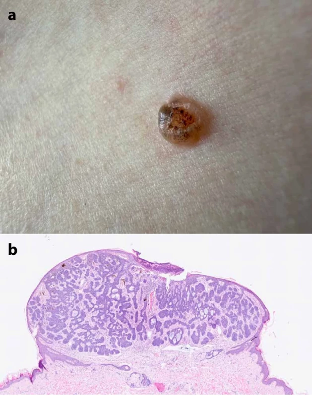  Detail klinického obrazu bazocelulárního karcinomu  trupu (a), histopatologický obraz – hematoxylin & eozin (b) 