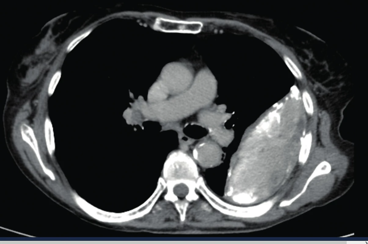 CT nález empyému, „split pleura sign“.