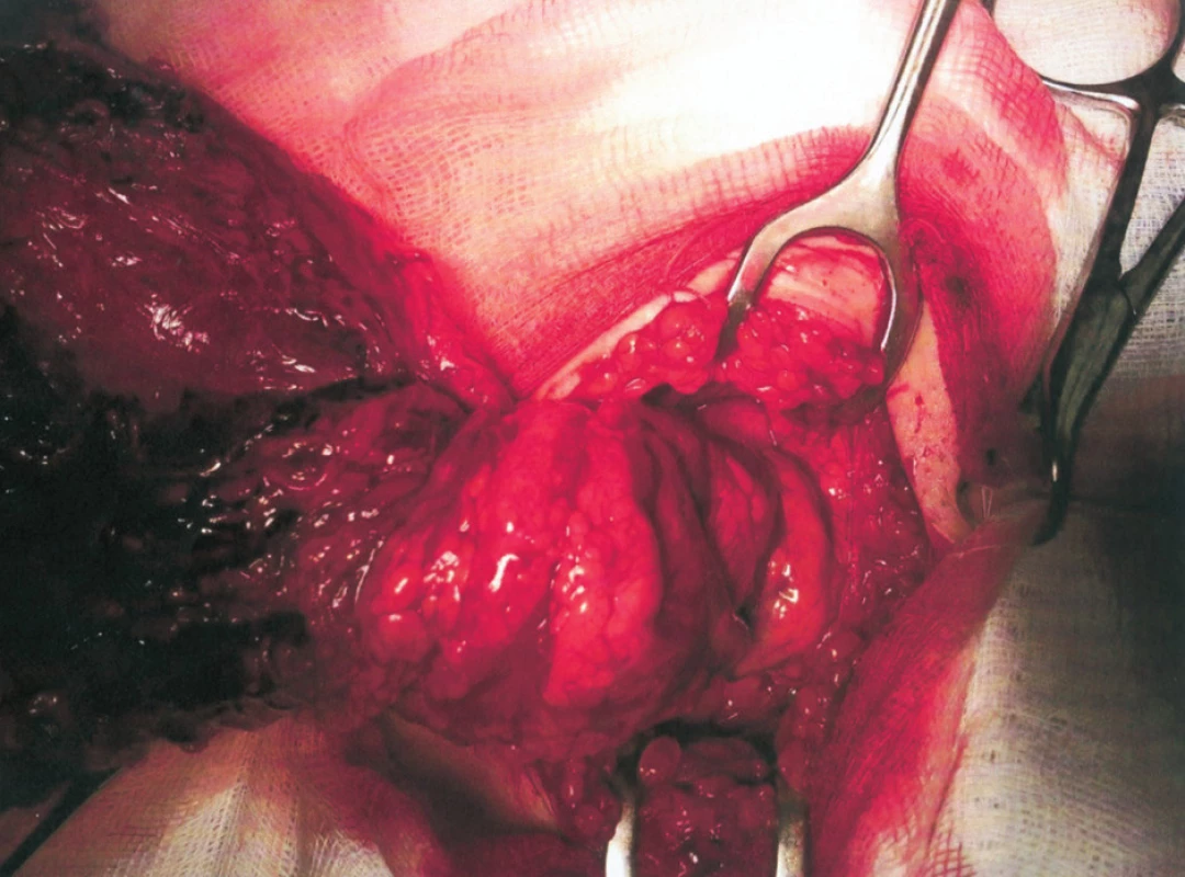 Torze velkého omenta v oblasti vaskulární stopky
Fig. 1. Torsion of the large omentum at its vascular stalk