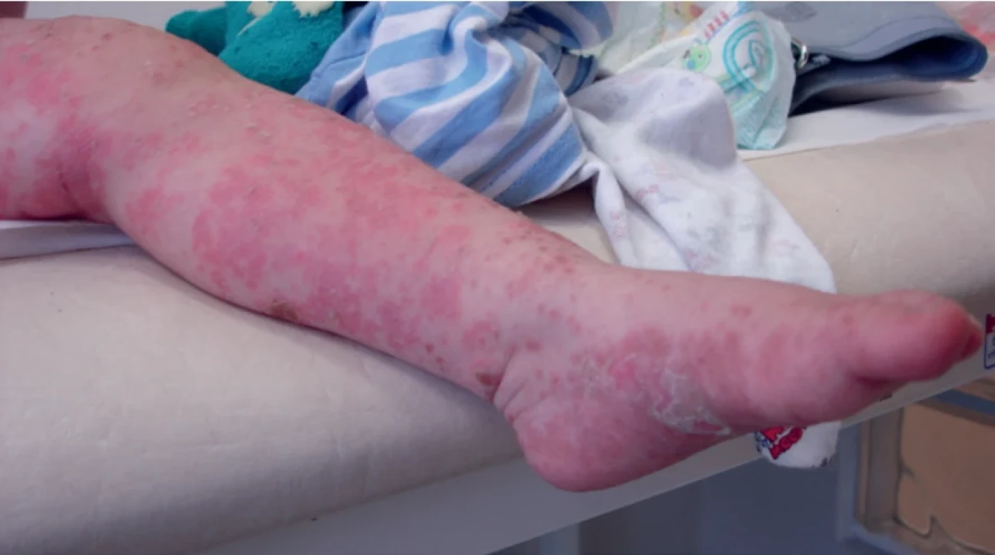  Nemoc rukou, nohou a úst (HFMD) – eczema coxsackium