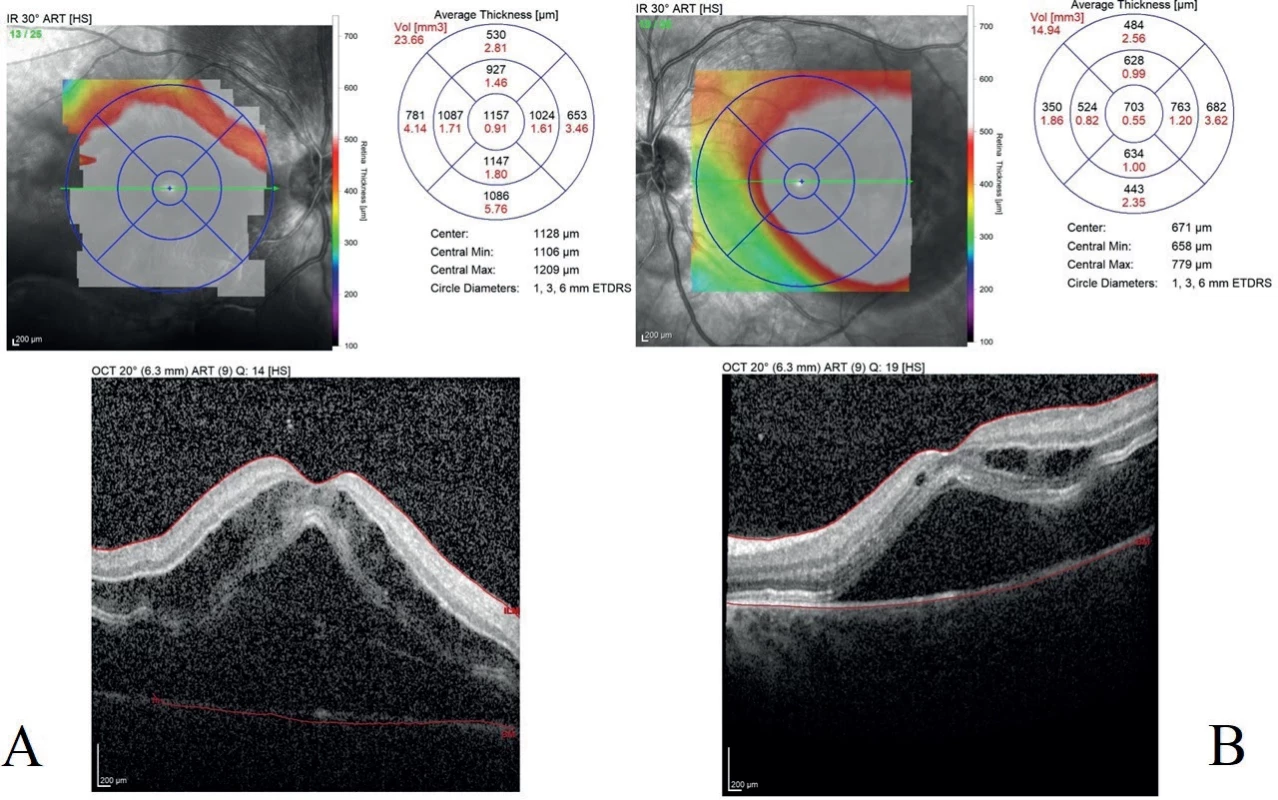 Optical coherence tomography (OCT) scans of the right (A) and left (B) eye performed at the time of diagnosis of exudative retinal detachment. The OCT images reveal the presence of both subretinal and intraretinal fluid