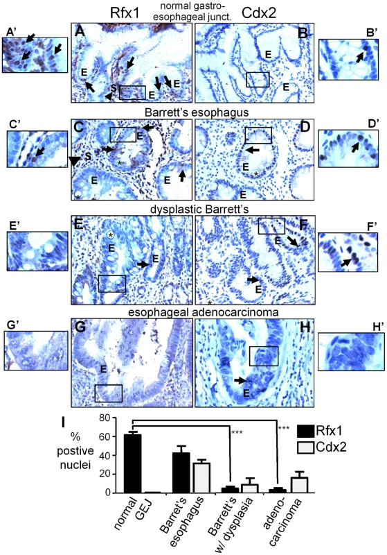 Rfx1 downregulation in esophageal adenocarcinoma.