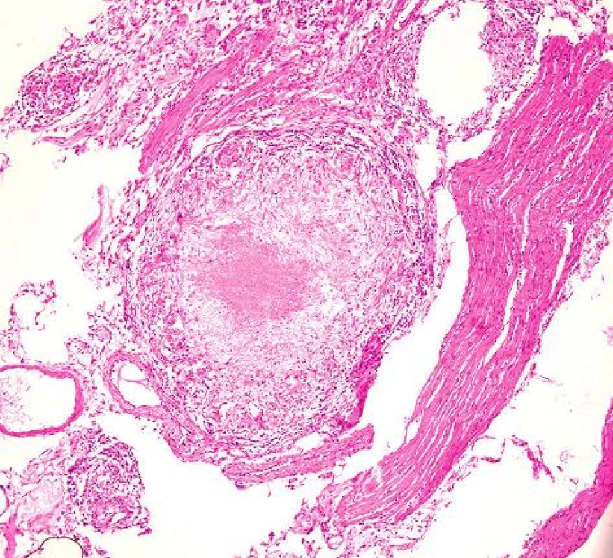 Histological finding of intestinal TB – granuloma with central caseous necrosis. HE, magnified 200x
