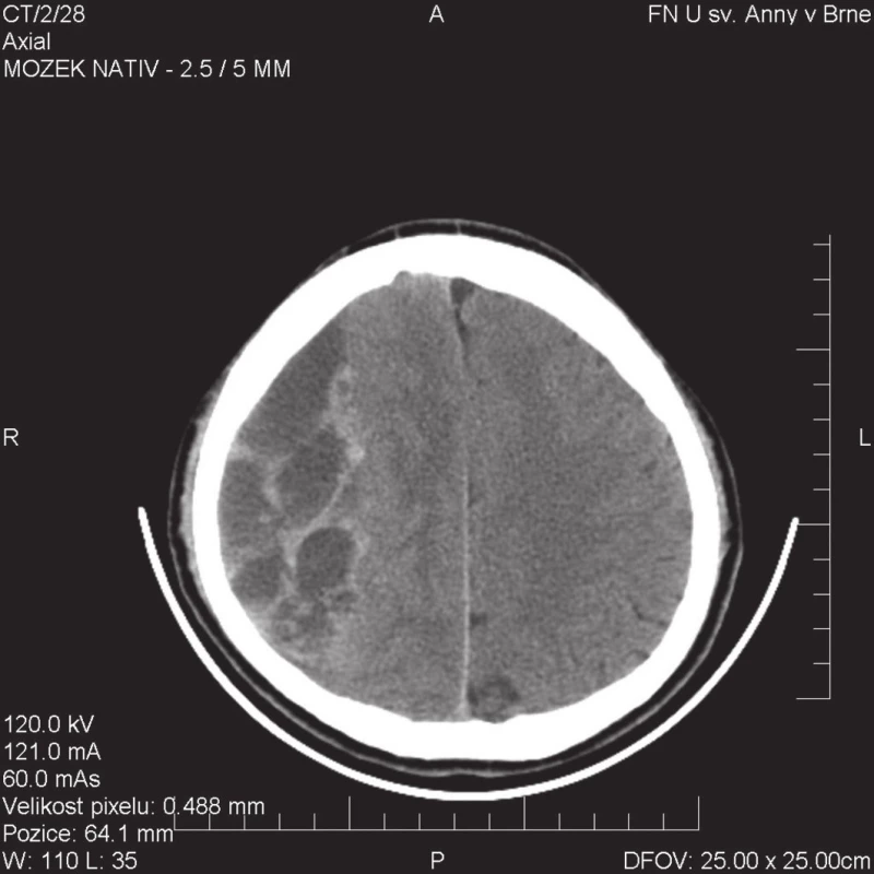 CT obraz septovaného CHSDH s minimem tekuté složky, nutné řešit primární kraniotomií
Fig. 2: CT image of septated CHSDH with minimum fluid component, primary craniotomy needed