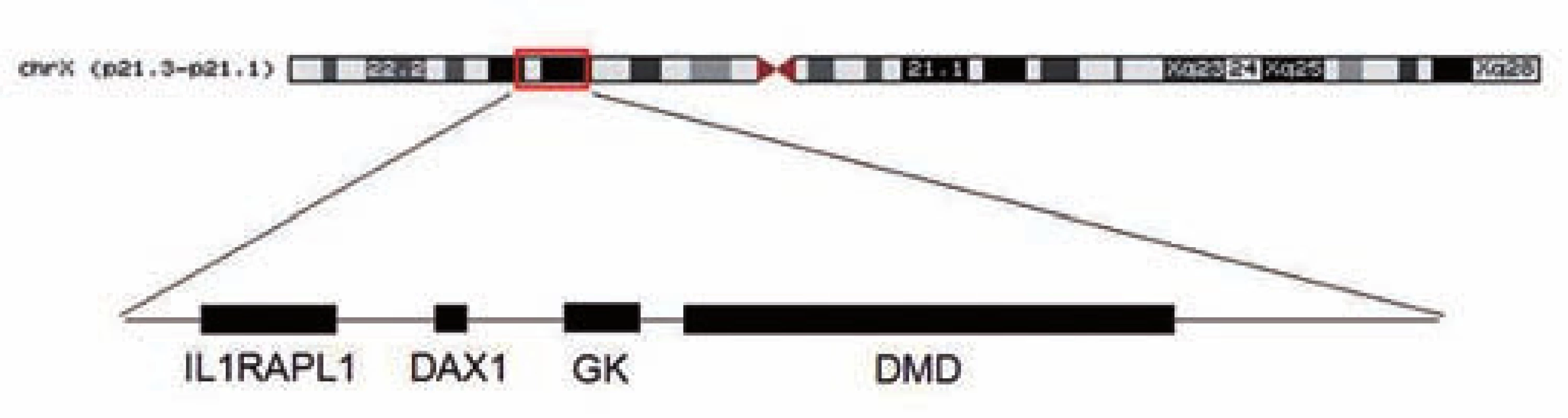 Mapa X chromozomu se zvýraznûnou oblastí p21.2p21.3, která je postižena mikrodelecí.
Fig. 3. X-chromosome map with highlighting the area p21.2p21.3, which is affected by microdeletion.