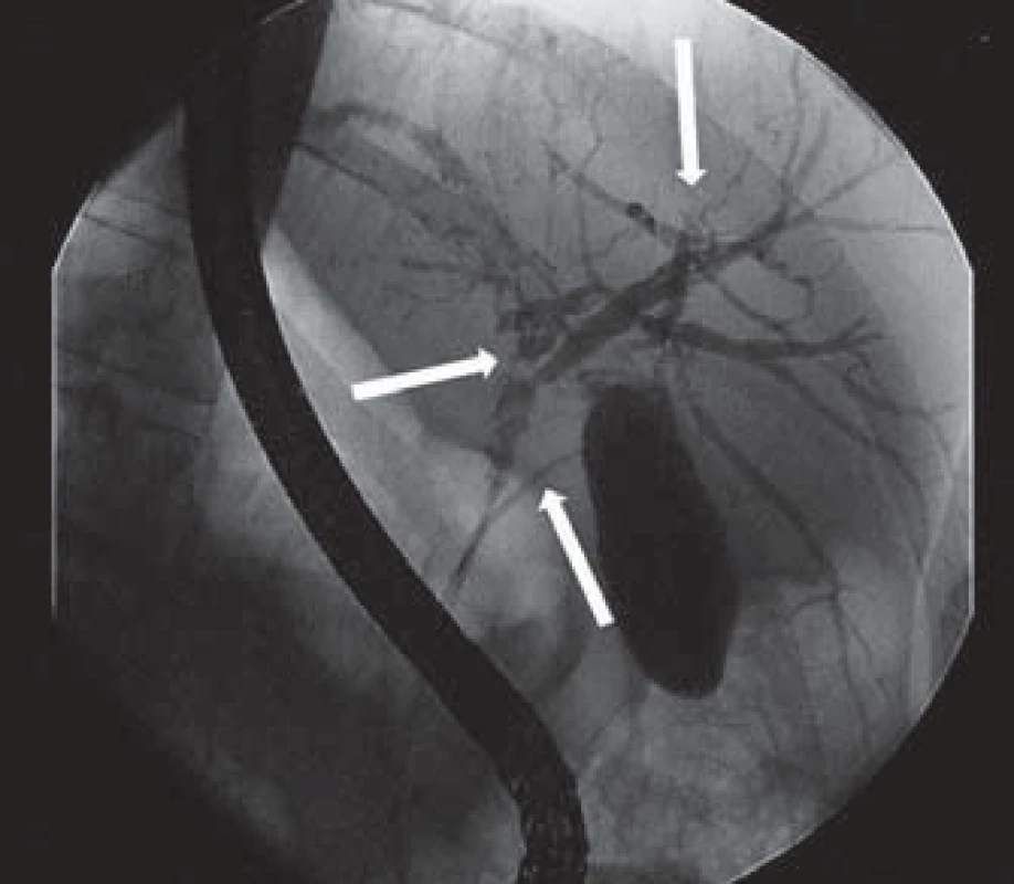 ERCP – mnohočetná litiáza v oblasti junkce pravého a levého ductus hepaticus, intrahepatální litiáza, štíhlý ductus choledochus a ductus cysticus (šipky).
Fig. 2. ERCP – multiple lithiasis in the junction between the right and left hepatic duct, intrahepatic lithiasis, thin bile duct and cystic duct (arrows).