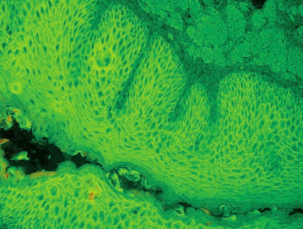 Pemphigus vulgaris – pozitivní intercelulární substance (nepřímá IF, opičí ezofagus, polyvalentní Ig)