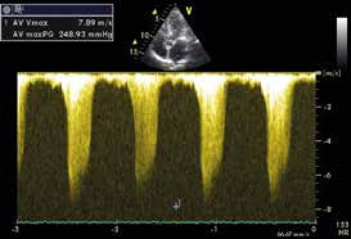 Extrémně vysoký gradient ve výtokovém traktu levé komory – kontinuální Doppler