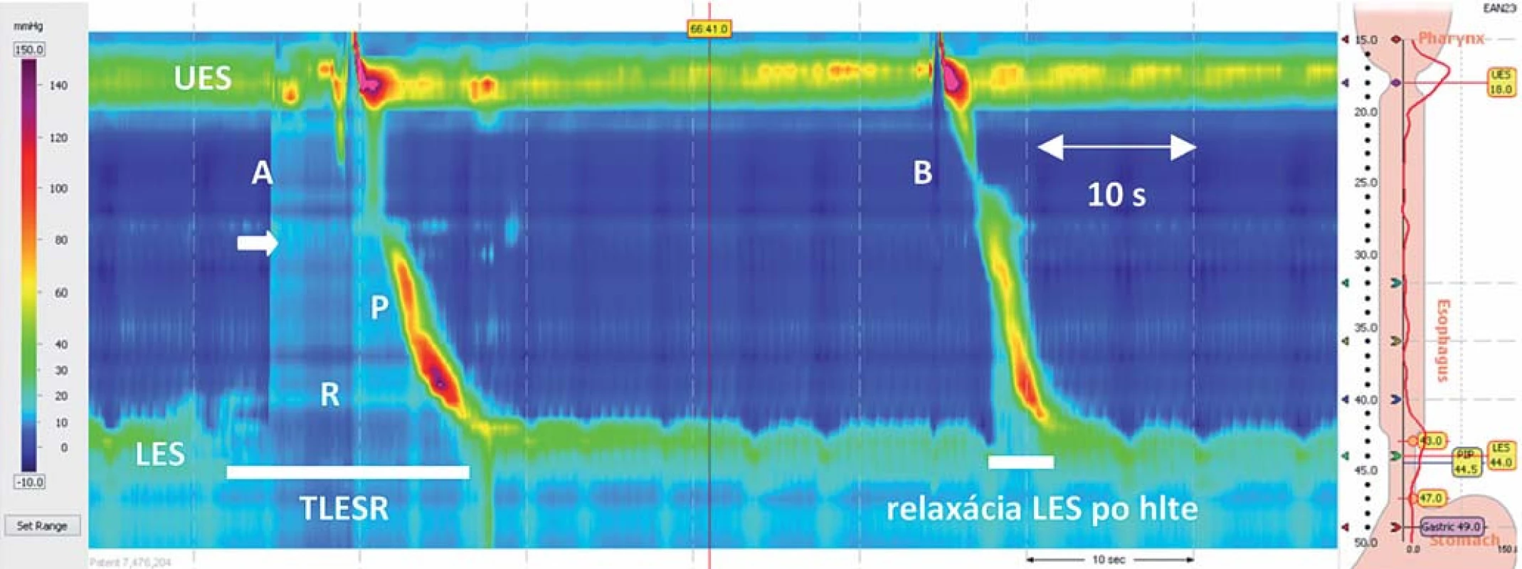 TLESR na high resolution manometrii (A), v porovnaní s hltom s primárnou peristaltikou (B). Počas TLESR dochádza k relaxácii dolného pažerákového zvierača (R), následne k zvýšeniu tlaku v lumene pažeráka – dôsledok uvoľnenia plynu zo žalúdka do pažeráka (šípka). TLESR je v tomto prípade ukončený primárnou peristaltikou (P).  Prevzaté z [12].
Obr. 1. TLESR in high resolution manometry (A) compared with a primary peristalsis swallow (B). Relaxation of the lower oesophageal sphincter (R), secondary increase of pressure in the oesophagus lumen caused by stomach gases released into the oesophagus (arrow). In this case, TLESR ends with primary peristalsis (P). Adapted from [12].