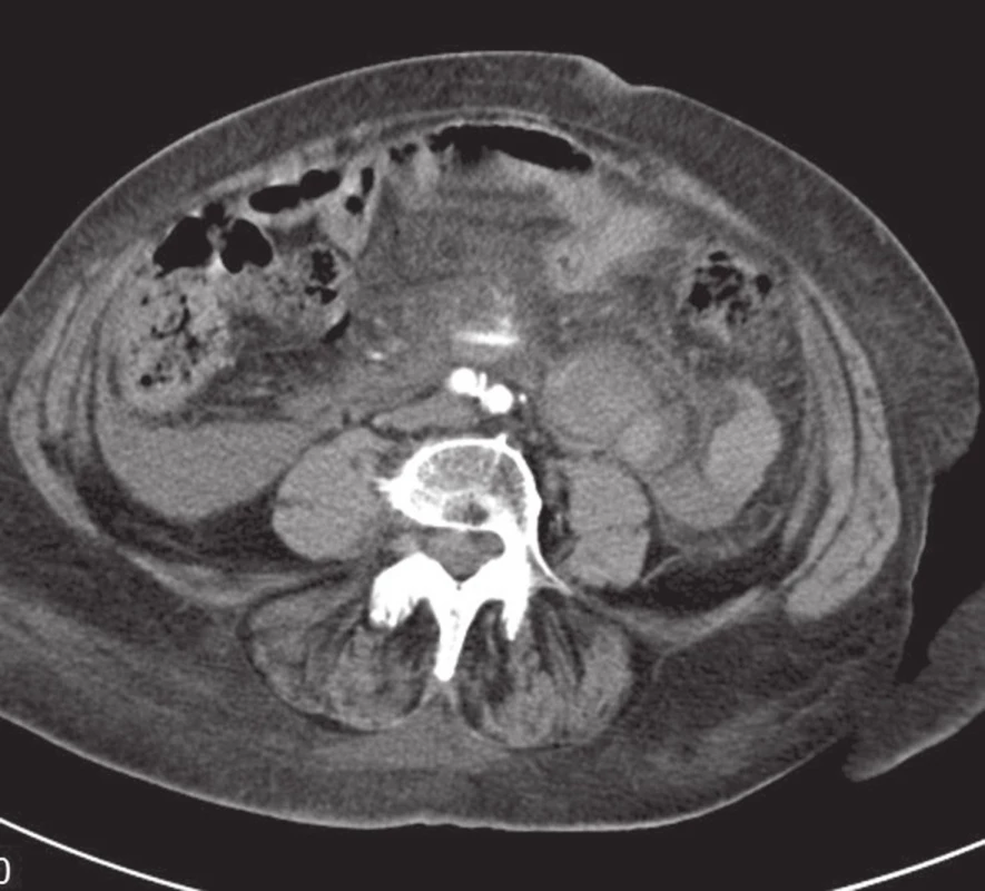 CT vyšetření v axiální rovině potvrzující krvácení v blízkosti horní mezenterické tepny
Fig. 3: Axial reconstruction of CT images confirming bleeding near the superior mesenteric artery