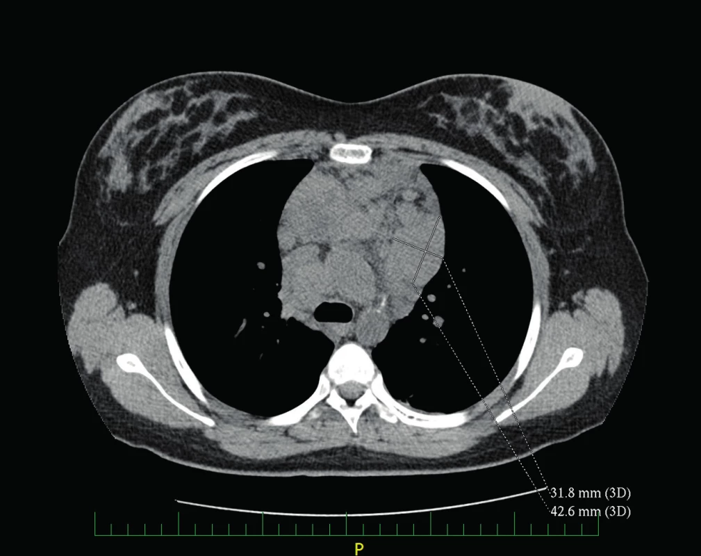 CT hrudníku – lymfadenopatie horního mediastina.
Fig. 2. Chest CT – superior mediastinum adenopathy.