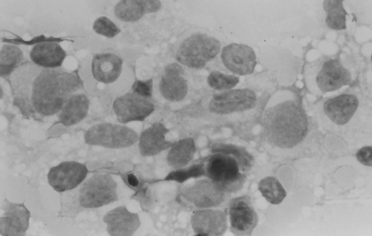 Punkcia kostnej drene: zmnožené makrofágy a monocyty.
Fig. 5. Puncture of bone marrow: multiplied macrophages and monocytes.