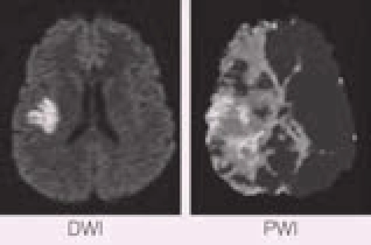 PWI/DWI mismatch, kdy DWI je rozsah již infarktové tkáně a PWI zahrnuje jak vlastní infarkt, tak oblast ohroženou, ale ještě reperfuzí zachranitelnou.