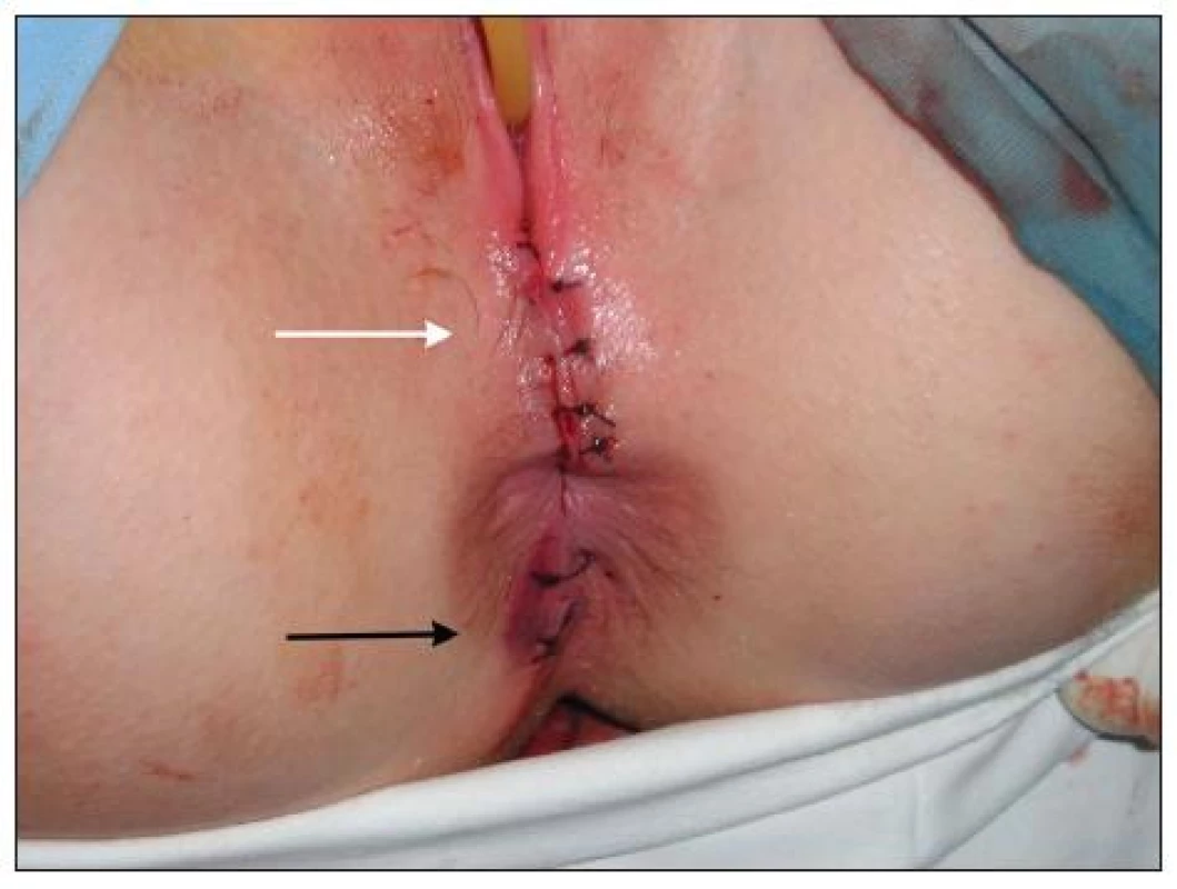 Stav po ošetrení poranenia; sutura incízie perinea (horná šípka); sutura povrchovej lacerácie v blízkosti anu (dolná šípka)
Fig. 3. Situation after surgery; suture of the perineal incision (upper arrow); suture of the superficial laceration near the anus (lower arrow)