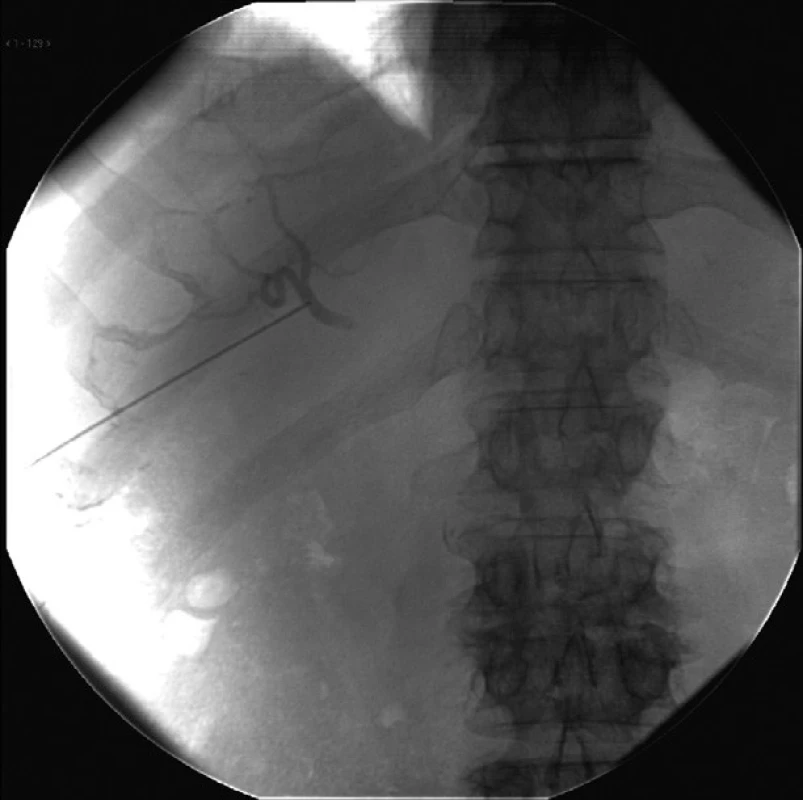 Napichnutie vnútropečeňovej artérie – arteria hepatica dextra
Fig. 4: Puncture of intrahepatic artery – right hepatic artery