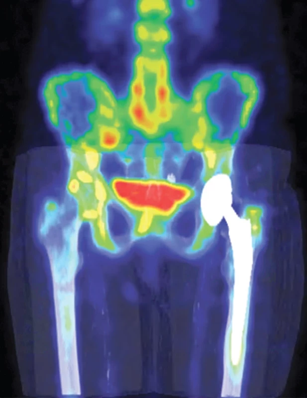 Fúze SPECT/CT MIP bederní páteře a pánve v pozdní fázi – zvýšená akumulace RF lokalizovaná u apexu dříku TEP levého kyčle a ve velkém trochanteru vlevo.