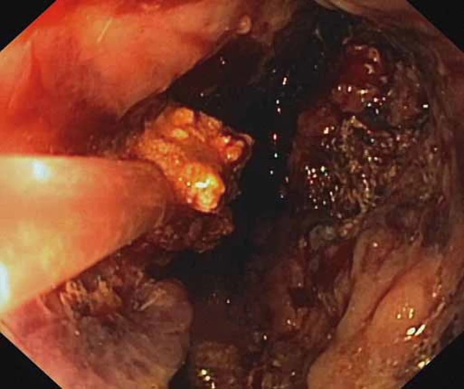 Endoskopická nekrektómia pomocou Dormia košíka.
Fig. 3. Endoscopic necrectomy using a Dormia basket.