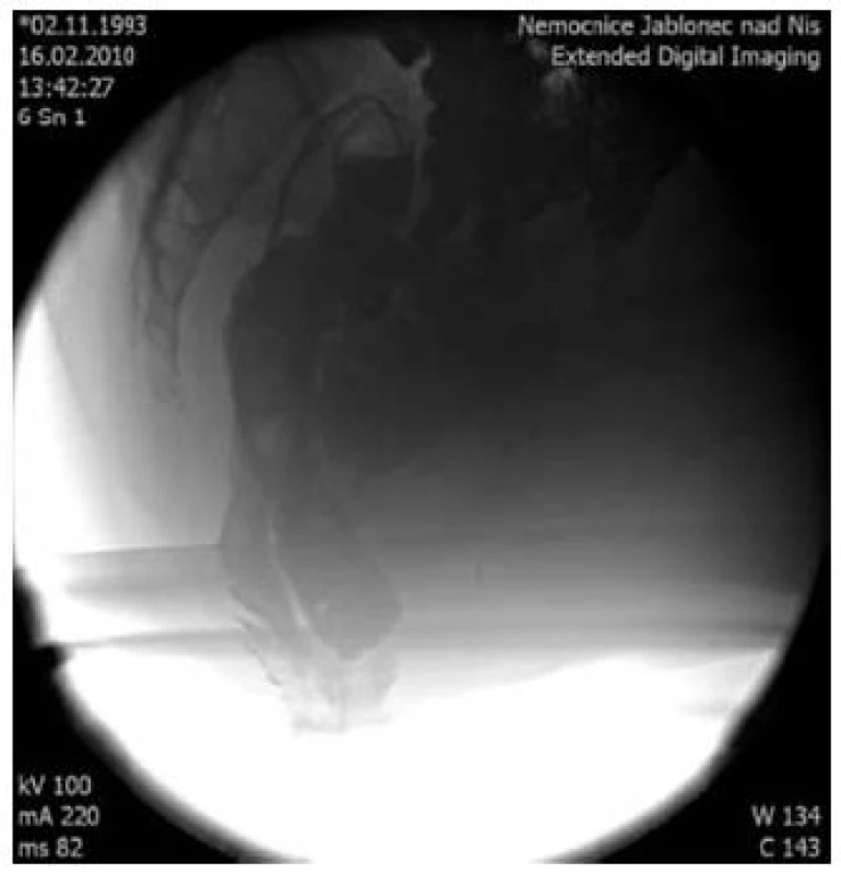 Defekografické vyšetření rektoanální intususcepce, enterokéla.
Fig. 6. Defecography of rectoanal intussusception, enterocele.