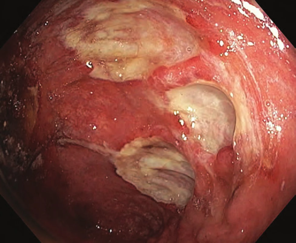 Ulcerace v orální polovině pahýlu rekta.
Fig. 3. Ulcers in the oral part of the rectal stump.