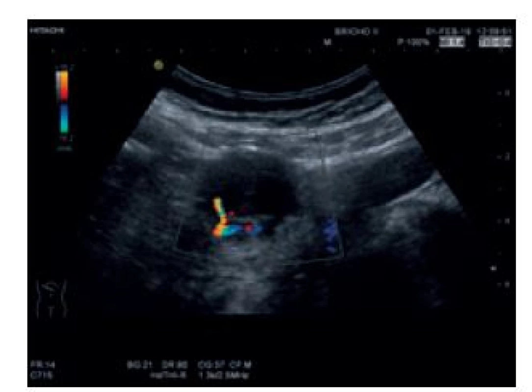 USG břicha a doppler.
