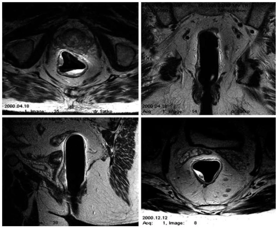 MRI – Endorektálny predterapeutický staging.
Fig. 1. MRI – endorectal pretherapeutic staging.