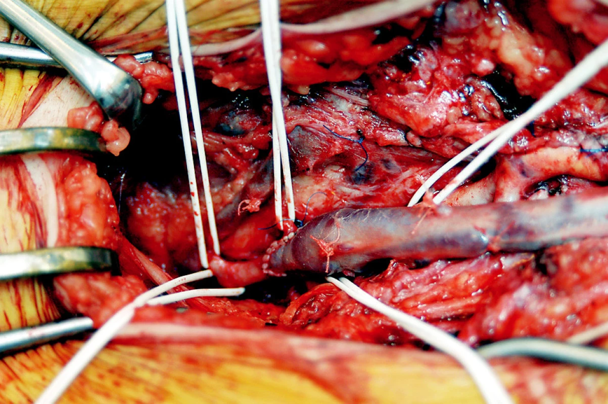 Detail distální anastomózy (end to side) žilního štěpu ke kmeni arteria profunda femoris asi 8 cm pod jejím odstupem ze společné stehenní tepny, která je po explantaci infikované cévní protézy ztrombozovaná. Arteria femoralis superficialis je chronicky uzavřena
Fig. 4. Detail of distal anastomosis (end-to-side) of the venous graft to the deep femoral artery trunk at about 8 cm below its division from the common femoral artery which was thrombolized after infected prosthesis explantation. The superficial femoral artery was chronically occluded
