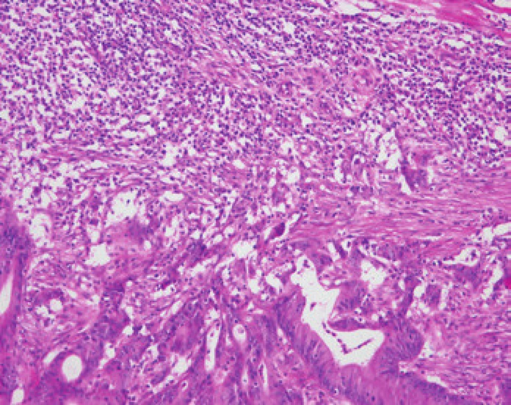 Příklad „MSI-H histologie“. Jeden z typických obrazů MSI-H CRC, zde představovaný zejména intraepiteliální lymfocytózou vytvářející v dolní části obrázku „posypání“ nádorových žlázek lymfocyty obklopenými světlými halo a souvislým lymfoidním lemem v horní části snímku (HE, původní objektiv 10×).
Fig. 1. Example of "MSI-H histology". One of the typical images of MSI-H CRC is represented in particular by intraepithelial lymphocytosis forming the "sprinkling" of cancer glandular cells with lymphocytes surrounded by bright halos at the bottom of the picture and continuous lymphoid band in the upper part of the image (HE, original lens 10×).