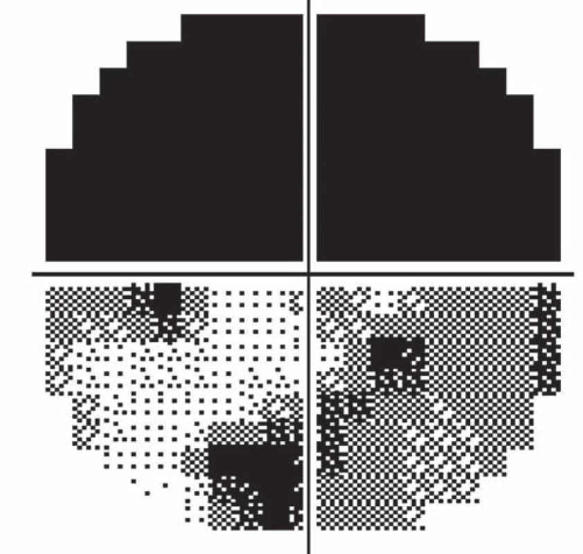 Worsening of the visual field of the left eye (after seven days).