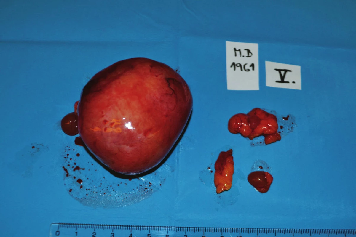 Infiltráty mezenteriální a peritoneální
Fig. 5: Mesenterial and peritoneal infiltrates