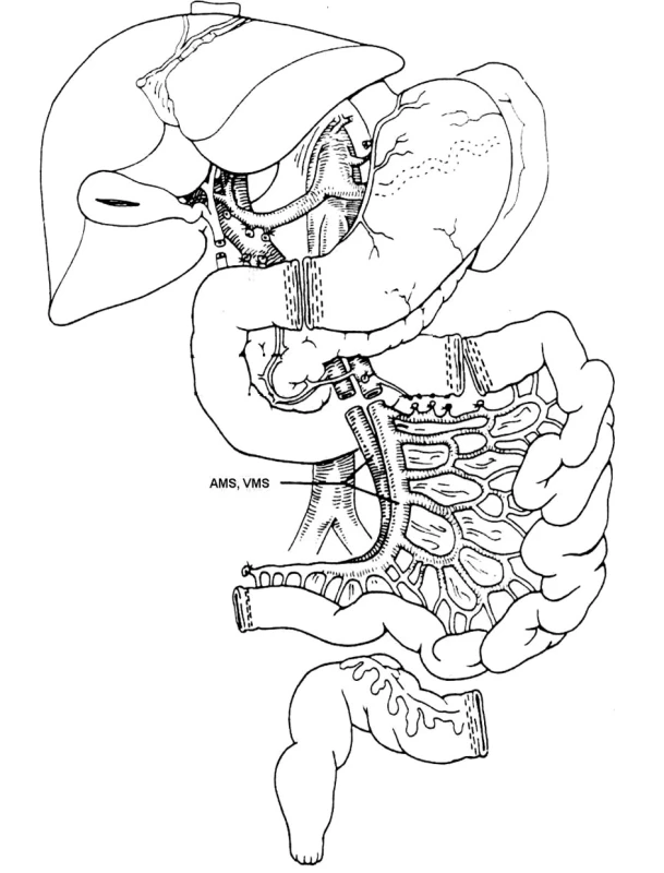 Schéma odběru štěpu tenkého střeva
Pic. 1. The small intestine graft collection – A scheme
AMS, VMS – a., v. mesenteria superior