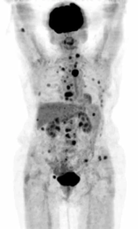 PET CT zobrazí postižení skeletu
MIP obraz (maximum intensity projections) biodistribuce FDG ve snímané oblasti, mimo fyziologickou aktivitu (v mozkové kůře, patrových tonzilách, ledvinách a močovém měchýři) se zobrazují četná hypermetabolická ložiska ve skeletu od kalvy až po pánevní kosti.