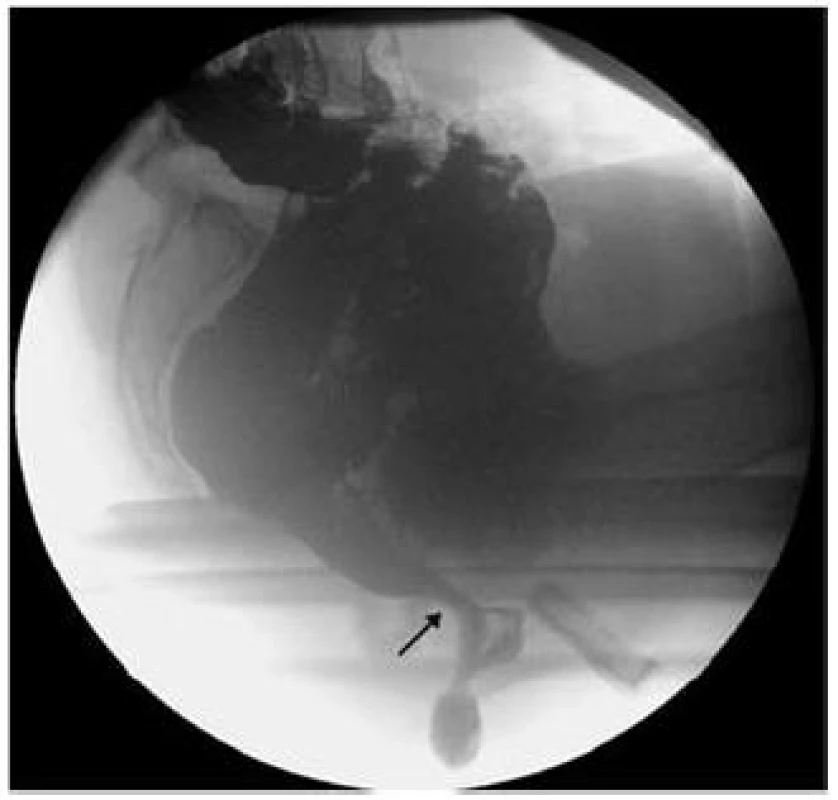 Spasmus puborektálního svalu (šipka) uzavírá vstup do análního kanálu, zmenšuje se anorektální úhel ARA.
Fig. 8. Musculus puborectalis spasm (arrow) blocking the entrance of anal channel and reducing anorectal angle (ARA).