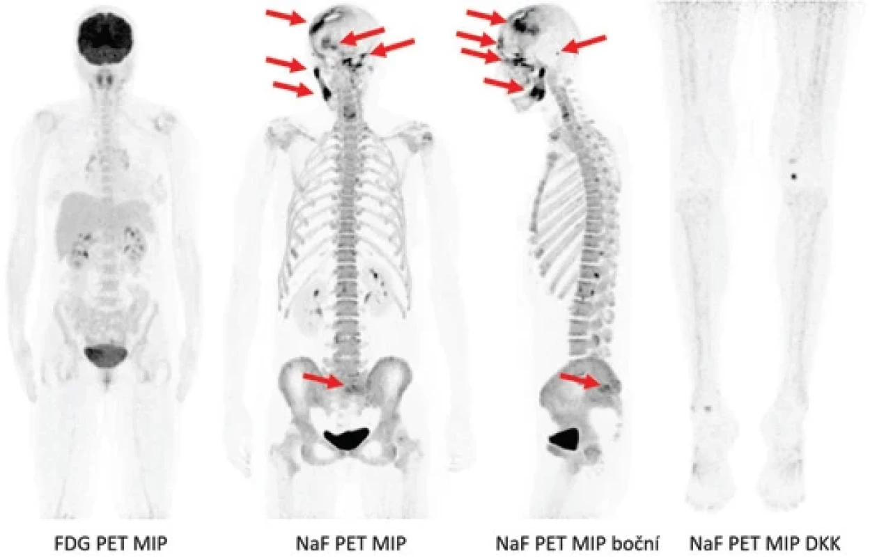 Kombinace FDG a NaF PET/CT vyšetření. Vyšetření s FDG neprokázalo ložiska s jasně patologickou akumulací, rozložení FDG od vertexu hlavy nad kolena je vcelku fyziologické. Naopak při vyšetření s NaF se zobrazila četná patologická ložiska v lebce oboustranně na více místech, v křížové kosti vlevo (označeno šipkami), dále sporná ložiska v L páteři, lopatě kyčelní vlevo. Vyšetření detekovalo i četné drobné degenerativní změny páteře a kloubů, zánětlivé změny v etmoidální dutině.
