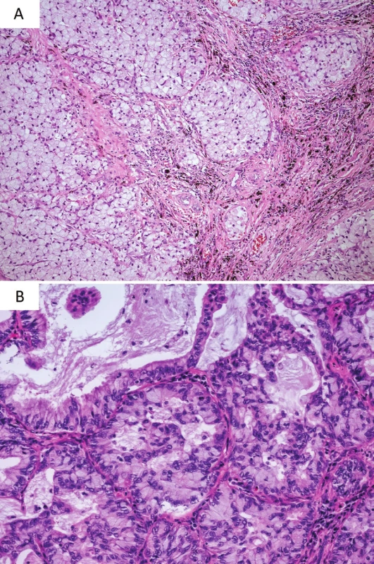 Morfologické varianty s častějším výskytem přestavby genu <i>ALK</i >; solidní tumor s morfologií buněk tvaru pečetního prstene (A, zvětšení 100x), acinárně rostoucí adenokarcinom s intra- i extracelulární hlenotvorbou (B, zvětšení 200x).