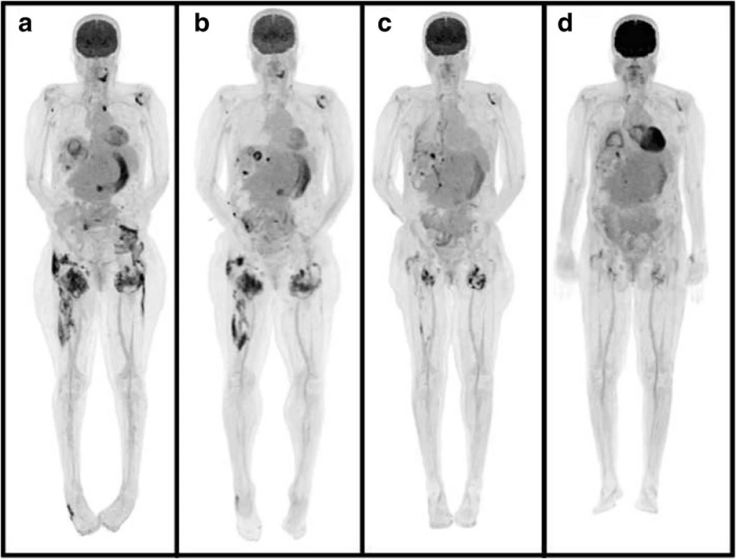 PET-CT images of the body illustrating tumoral calcinosis around the cervical spine, shoulders, left sternoclavicular joint, right buttock, hips, thighs, and right lateral midfoot at presentation a. These lesions dissipated after daily hemodialysis initiation in-hospital at 1 b and 2 c months later and at 2 months following hospital discharge d