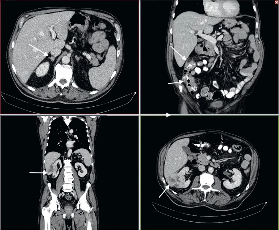 Abdomen CT. A) Pheochromocytoma in the right adrenal gland. B) Stenotising circular carcinomas of the caecum and hepatic flexure. C) and D) Clear cell tumour of the kidney.