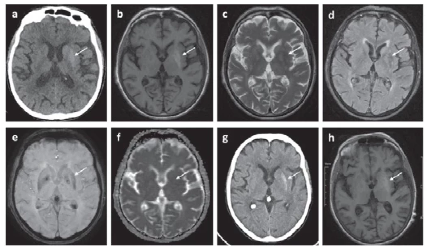 Initial and follow-up ımaging fi ndings consistent with NHH in a 75-year-old female patient presenting with hemiballism in the right arm.