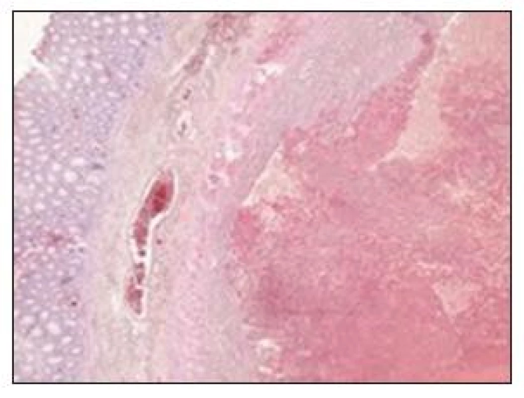 Rozsiahle krvácanie v subseróznom tukovom tkanive mezenteria
Fig. 9. Massive bleeding in the mesenteric subserous adipose tissue