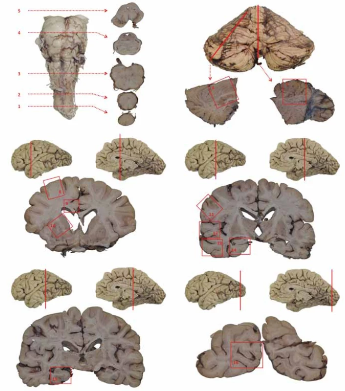 Schéma základního odběru při pitvě mozku.
1 – segment C1; 2 – bulbus; 3 – prodloužená mícha; 4 – pons na úrovni locus coeruleus; 5 – mezencefalon na úrovni odstupu n. III. se substantia nigra; 6 – hemisféra mozečku; 7 – vermis; 8 – frontální kortex (střední frontální závit); 9 – gyrus cinguli; 10 – bazální ganglia – striatum; 11 – somatomotorický kortex; 12 – horní temporální závit (T1); 13 – střední a dolní temporální závit (T2, 3); 14 – přední hipokampus; 15 – zadní hipokampus; 16 – primární zraková kůra
Fig. 1. Basic brain areas sampled during autopsy. 1 – C1 segment; 2 – bulbus; 3 – medulla oblongata; 4 – pons at the level of the locus coeruleus; 5 – midbrain at the level of the oculomotor nerve with substantia nigra; 6 – cerebellar hemisphere; 7 – vermis cerebelli; 8 – frontal cortex (middle frontal gyrus); 9 – cingular gyrus; 10 – basal ganglia – striatum; 11 – somatomotor cortex; 12 – superior temporal gyrus (T1); 13 – middle and inferior temporal gyrus (T2, 3); 14 – anterior hippocampus; 15 – posterior hippocampus; 16 – primary visual cortex