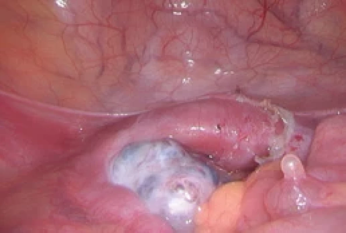 Laparoscopický obraz dělohy a levého ovaria. Fig. 5. Laparoscopic image of the uterus and left ovary.