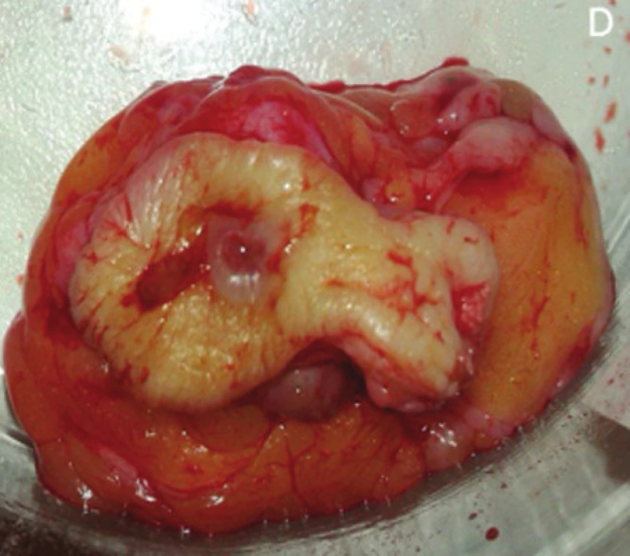 a, b) nasondovanie fistuly ductus lactiferi lakrimálnou sondou, c) excízia fistuly ductus lactiferi, celého retroglandulárneho tkaniva, kavity abscesu a duktálneho tkaniva v bradavke, d) klinovitý resekát bradavky s excíziou patologického duktu a kavitou abscesu a fistuly
Fig. 2: a, b) fistula of lactiferous duct probed by a lacrimal probe; c) excision of the fistula of lactiferous duct, whole retroglandular tissue, abscess cavity and ductal tissue within the nipple; d) a wedge-shaped resected nipple with the excision of pathological duct and with the abscess cavity and fistula