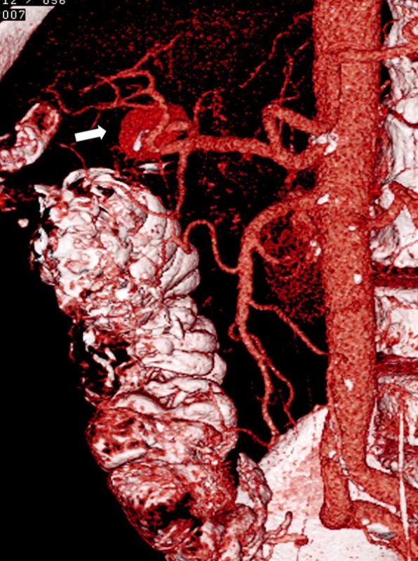 CT angiografie, 1. rekonstrukce – v horní části je patrná pseudovýduť arteria hepatica dextra (označeno šipkou)
Fig. 1. CT angiography, 1st reconstruction – proximally, a pseudoaneurysm of the right hepatic artery is detectable (marked with arrow)