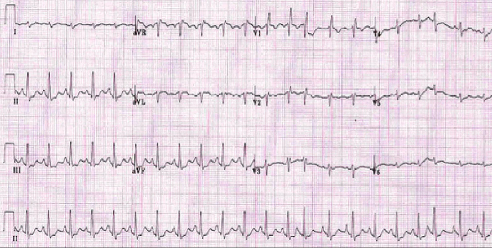 EKG u nemocného s CHOPN:
P pulmonale, blok pravého Tawarova raménka, hypertrofie pravé komory a ojedinělá supraventrikulární extrasystola.