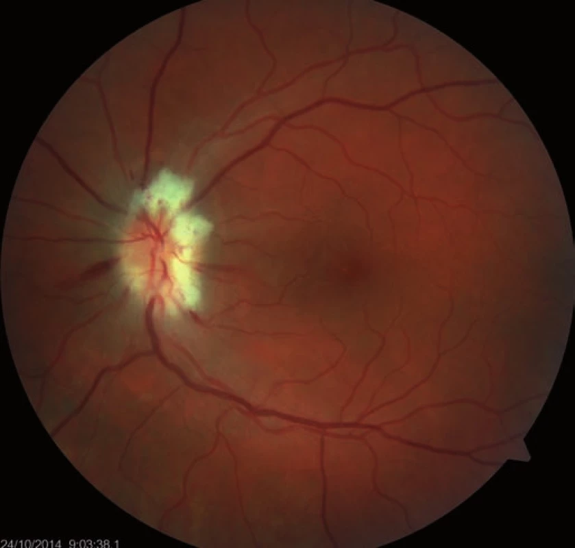 Regression of the optic nerve disc edema after decompression of optic nerve sheaths.