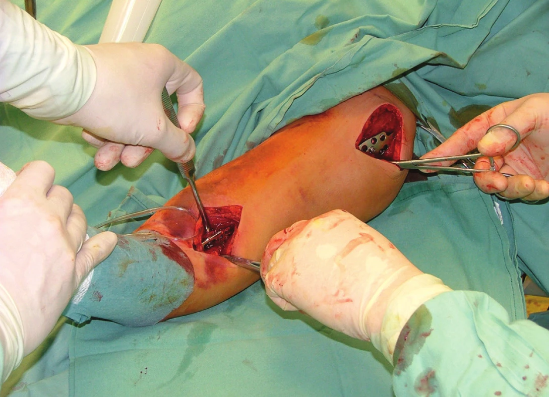 Peroperační foto při podvlékání dlahy
Pic. 1. Peroperative picture