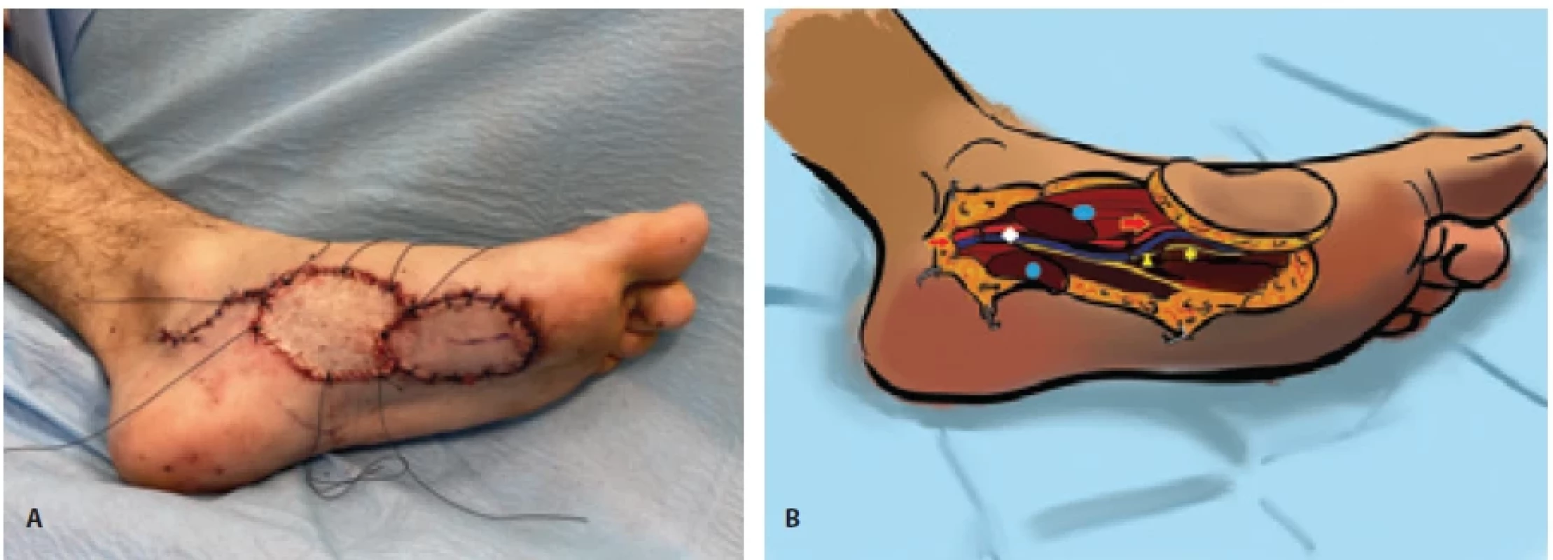 Result after the advancement fl ap surgery using the greater saphenous vein loop to elongate the vascular pedicle. A) The donor site has been covered with a full thickness skin graft from the right groin area; B) schematic representation with the following detailed structures: abductor hallucis sectioned muscle (blue circle), sectioned medial plantar vascular pedicle (red arrow), greater saphenous vein loop (white diamond), medial plantar sensory nerve of the fl ap (yellow star) and recipient nerve stump of the sensory branch of the medial plantar nerve (yellow triangle).